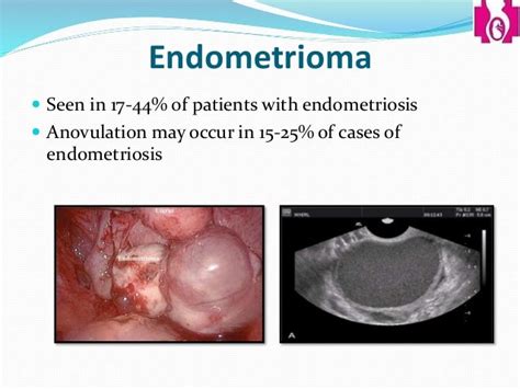 fulguration of endometriosis cpt code